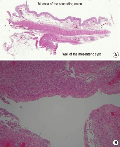 nasolabial cyst histology